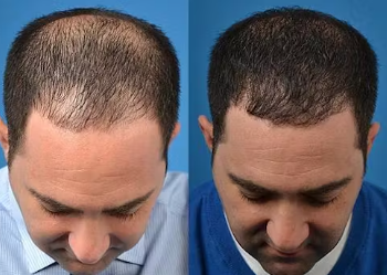 Millions of people all around struggle with Hair loss.